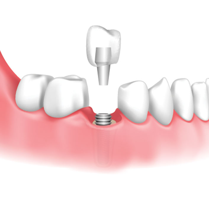 Dental Implant Restoration - Dental Services