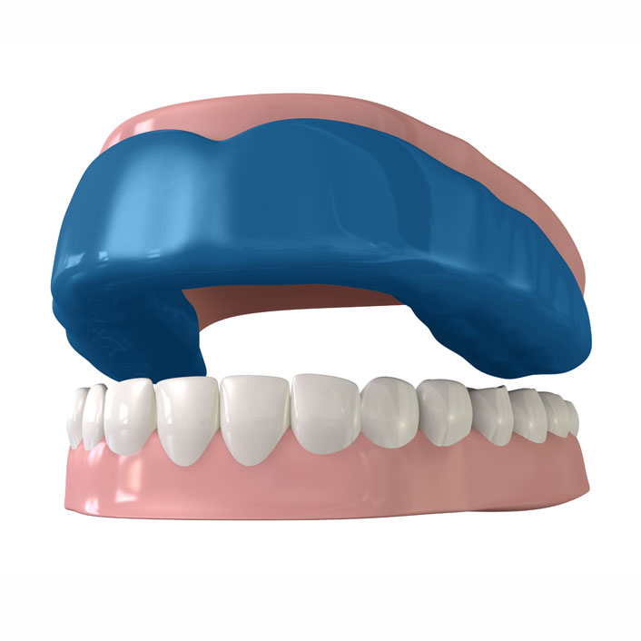 Mouth Guards - Dental Services